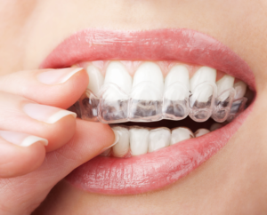 Perfect Smiles: 7 Simple Advantages of Metal Braces 