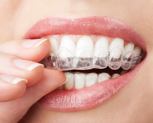 What are Invisalign Clear Braces? - Stoney Creek Dental