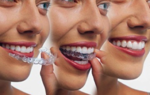 invisalign vs. braces parkland fl