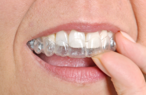 Invisalign Coral Springs