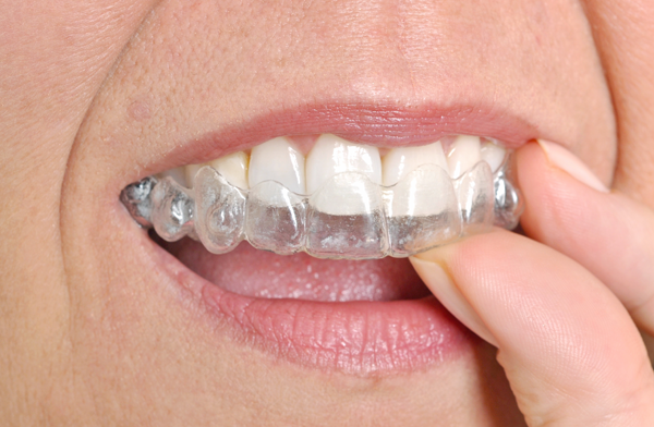 Can Anyone Get Clear Braces? - Metro Smiles Dental Forest Hills New York