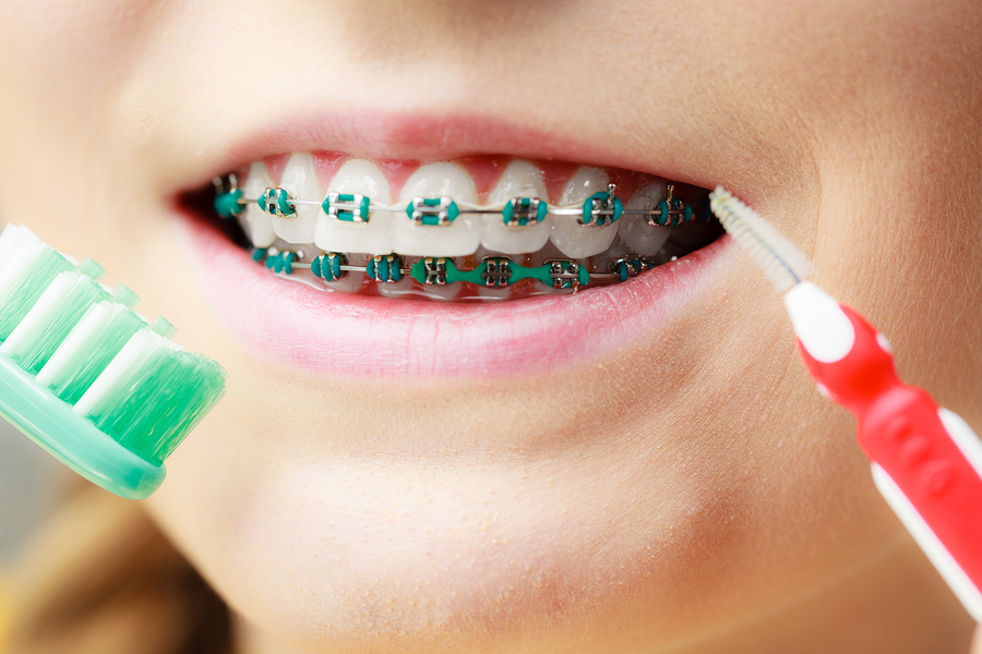 Braces in Coral Springs FL John Orthodontics Learn More
