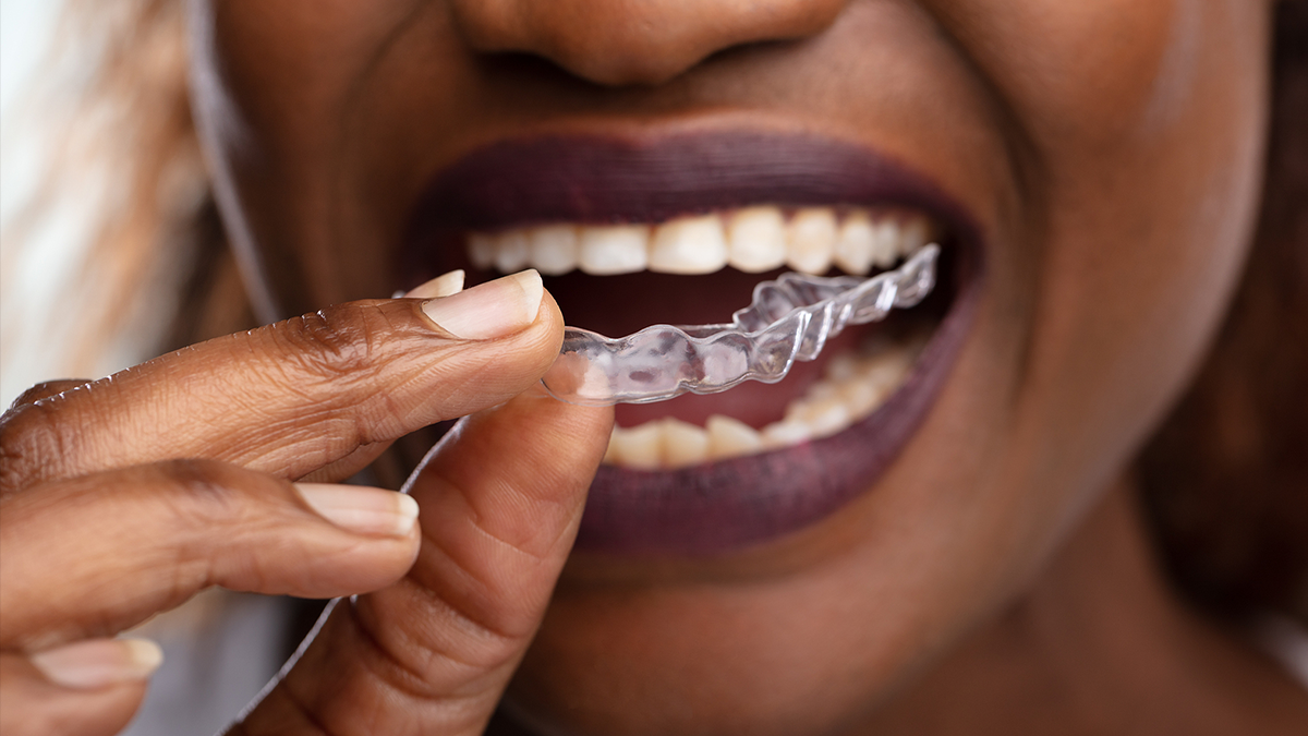 How expensive is Invisalign? Find out what to expect in Coral Springs