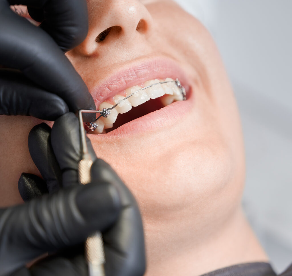 Close up of an adult with braces getting an adjustment