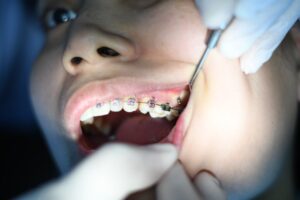 Orthodontist Boca Raton