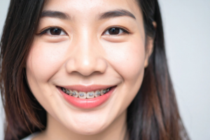 What Makes an Orthodontist the Best Choice for Braces